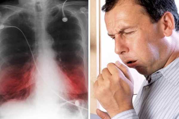 Может ли быть пневмония без температуры и без кашля у взрослого: при коронавирусе