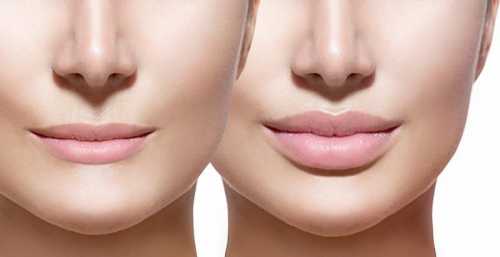 Чи безпечно збільшувати губи за допомогою гіалуронової кислоти
